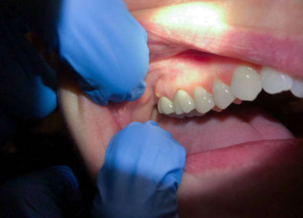 Best Emergency Root Canal Therapy in Menonee, MI